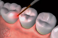 Laser Assisted Gum Treatment
